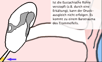 Erklärung Barotrauma Ohr, Schritt 4: